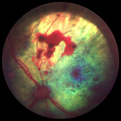 Een beeld van de binnenkant van een oog met cataract