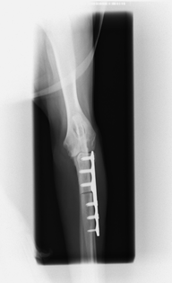 proximal abducting ulnar osteotomy