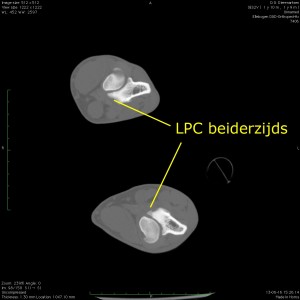 Beiderzijds lpc met tekst
